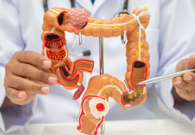 Colon irritabile, quali alimenti evitare e perché possono peggiorare i sintomi