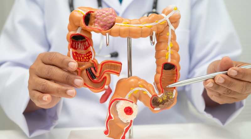 Colon irritabile, quali alimenti evitare e perché possono peggiorare i sintomi